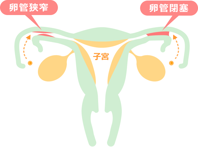 鍼灸とAKAによる骨盤矯正 イラスト